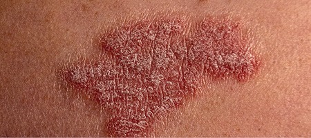 Types of Psoriasis - Guttate Psoriasis